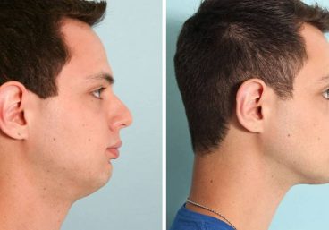 antes-despues-microliposuccion-de-papada-clinica-fontana-1024x576
