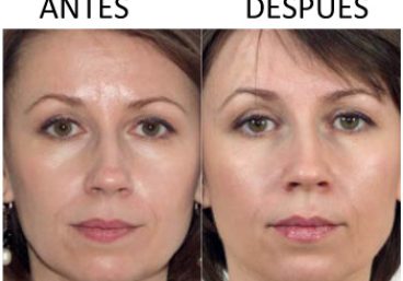 antes_despues-meso