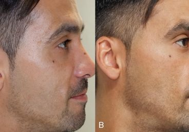 estudio-comparativo-de-la-aplicacion-de-prp-contra-placebo-despues-de-un-peeling-con-acido-mandelico-rrss