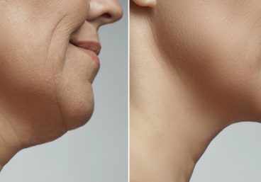 liposuccion-de-papada