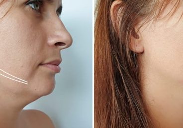 microliposuccion-papada-clinica-fontana