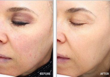 prp-facial-e1546938480830