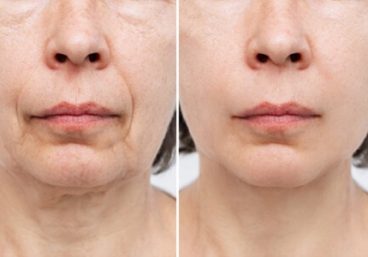 tratamiento-prp-facial-antes-y-despues
